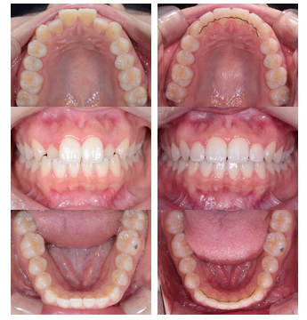 Элайнеры в Корее: план лечения для приезжих · 2